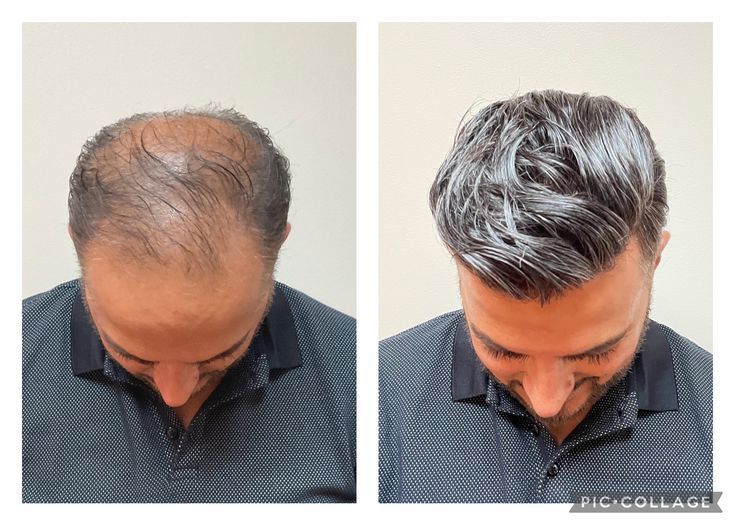 FEG+ Advanced Hair Regrowth Duo (Serum + Spray)