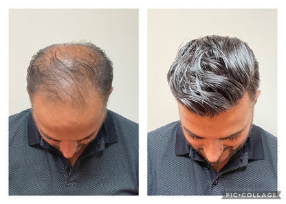 FEG+ Advanced Hair Regrowth Duo (Serum + Spray)