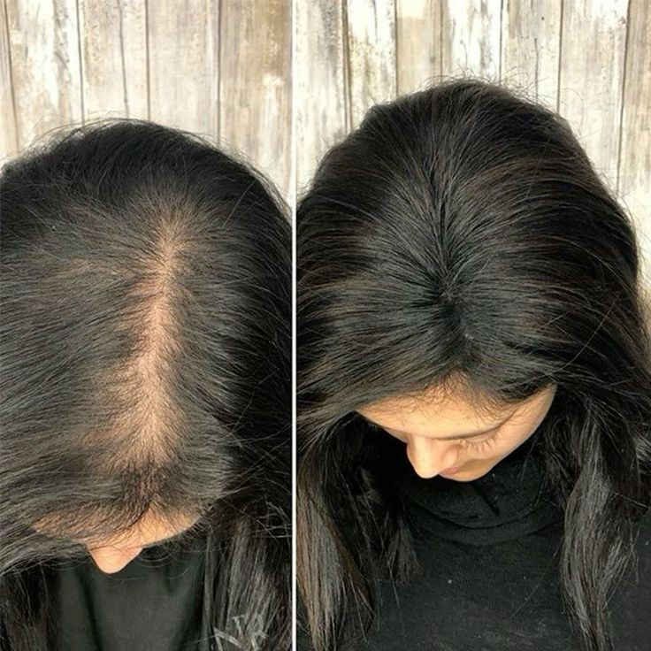 FEG+ Advanced Hair Regrowth Duo (Serum + Spray)